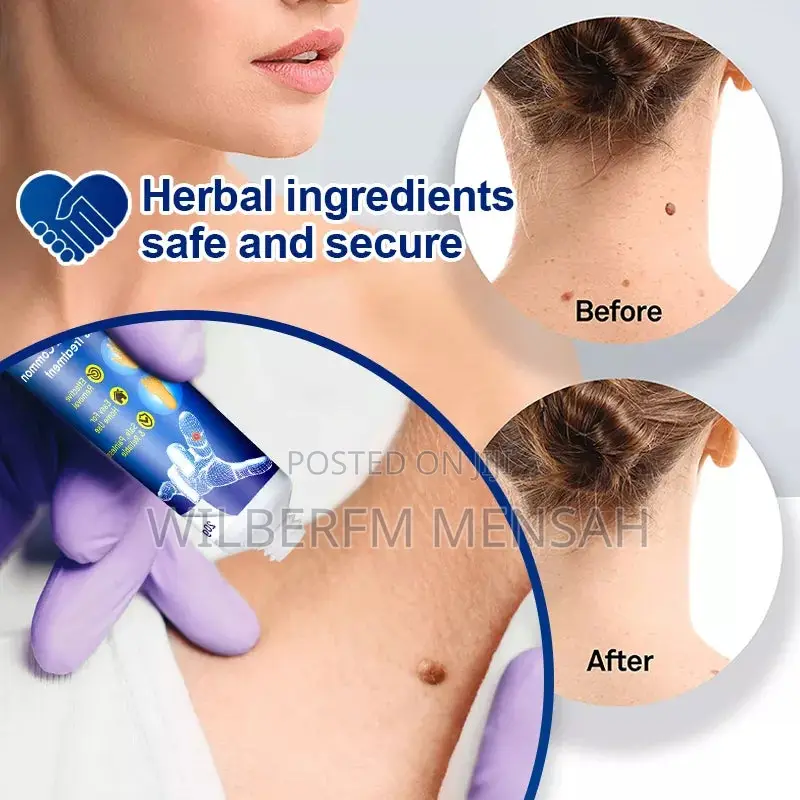 Wart Remover Ointment