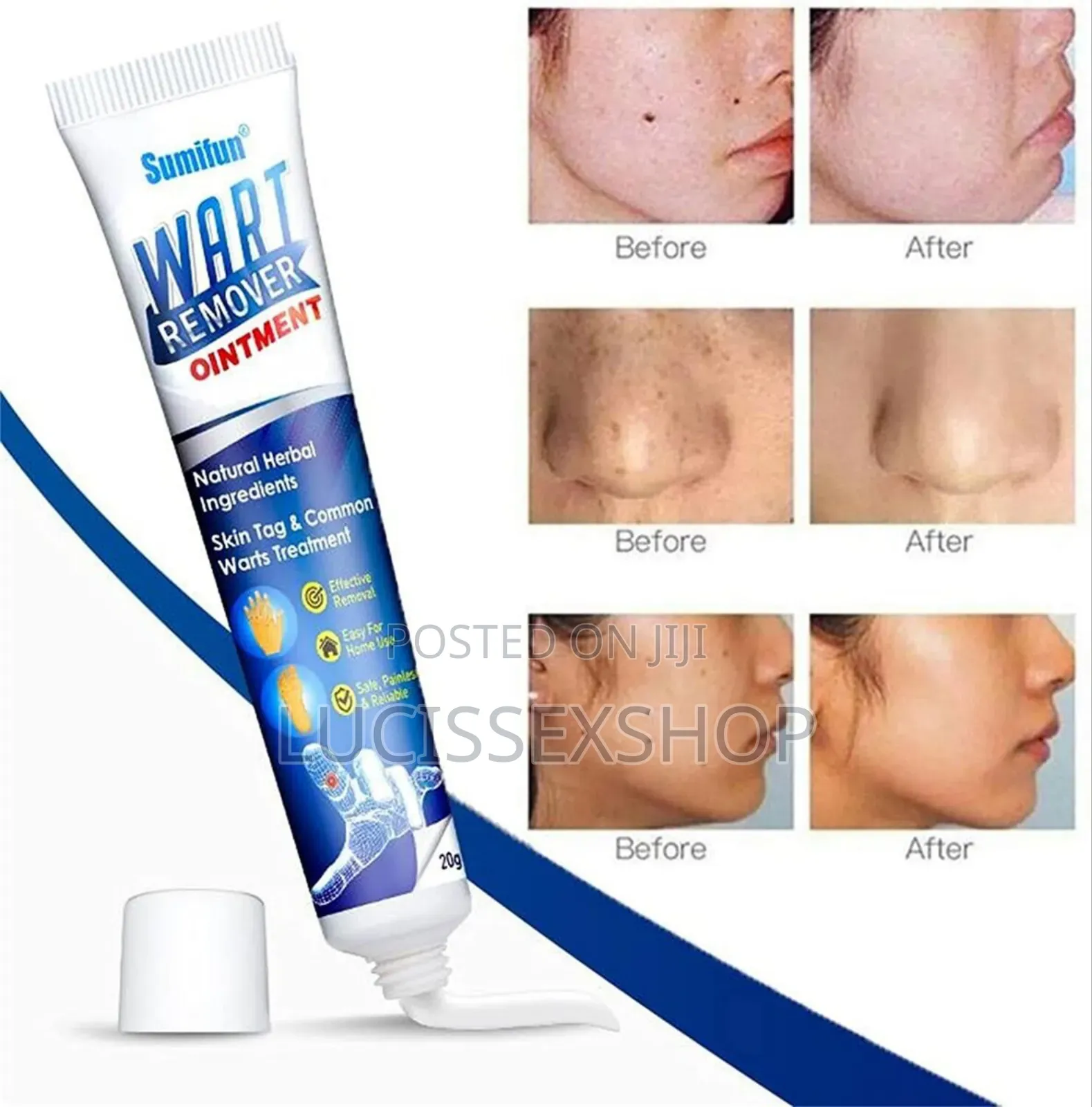Genital Wart Removal Cream