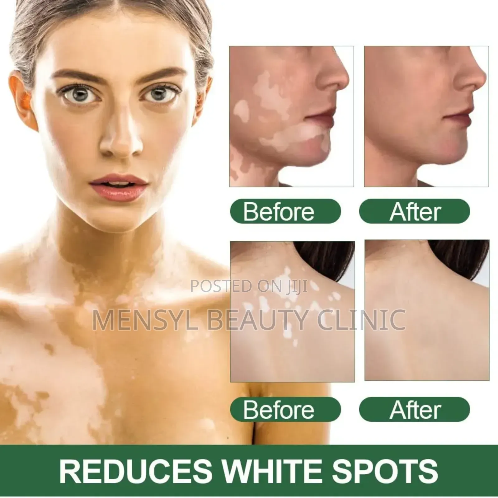 Vitiligo Cream Reduces White Spots on Skin