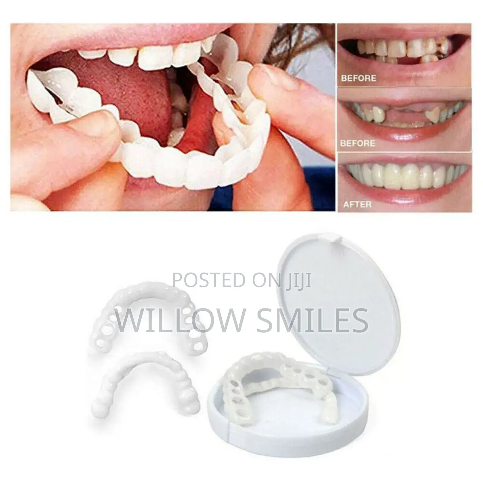 Snap on Veneers + 1 Box of Mouthwash Free Delivery in Accra
