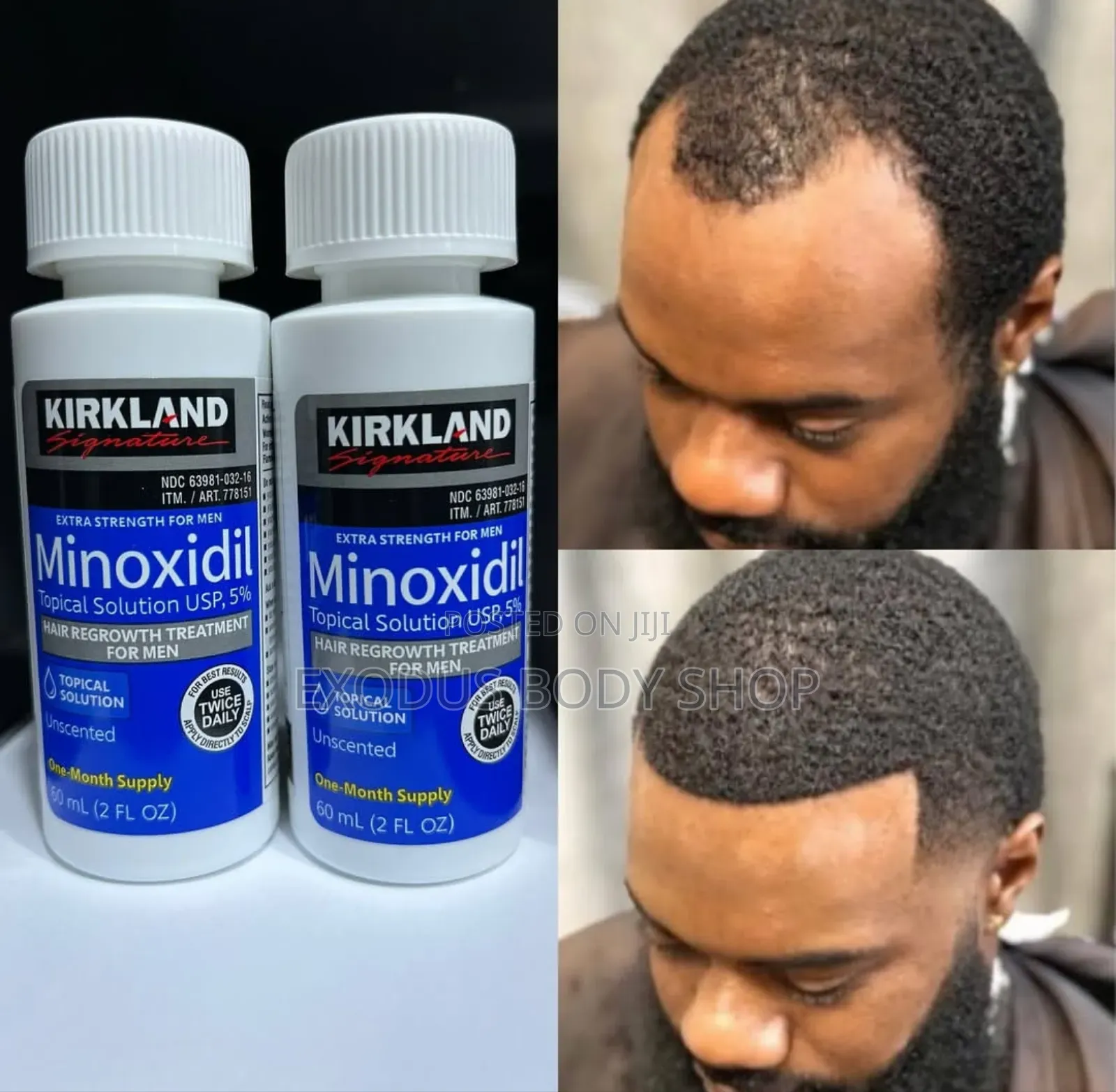 Kirkland Minoxidil Hair Regrowth Oil for Baldness Treatment (Costco)