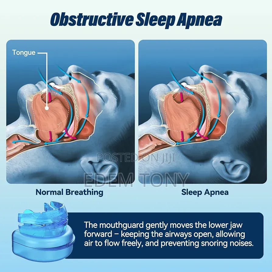 Adjustable Anti-Snoring Mouth Guard – Sleep Aid for Snore