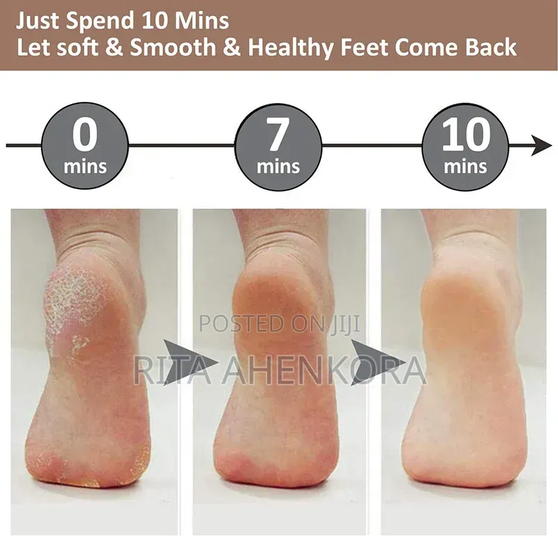 Rechargeable Callus Remover