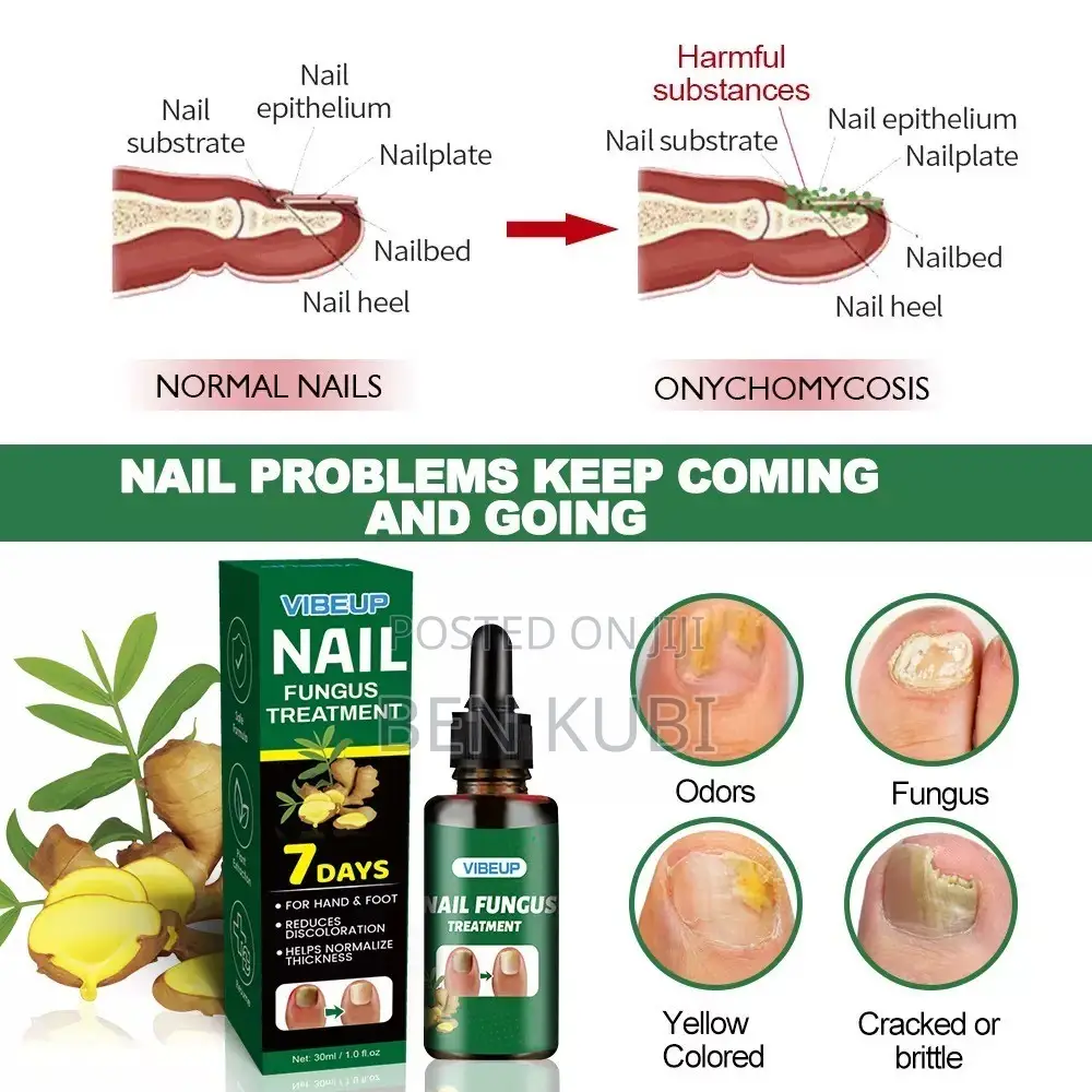 Nail Fungus Treatment