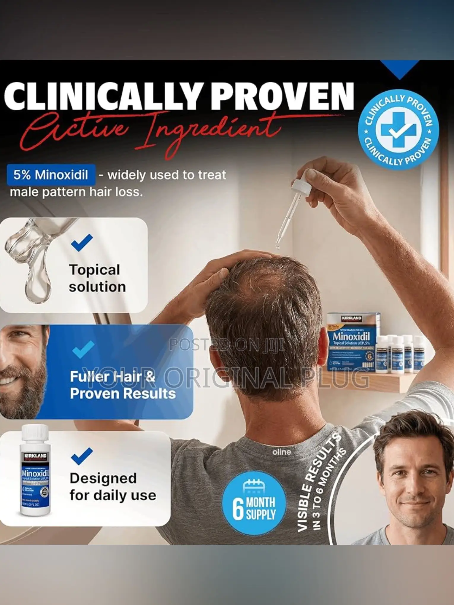 Kirkland Minoxidil 5% - Original, the Ultimate Hair Loss Solution.