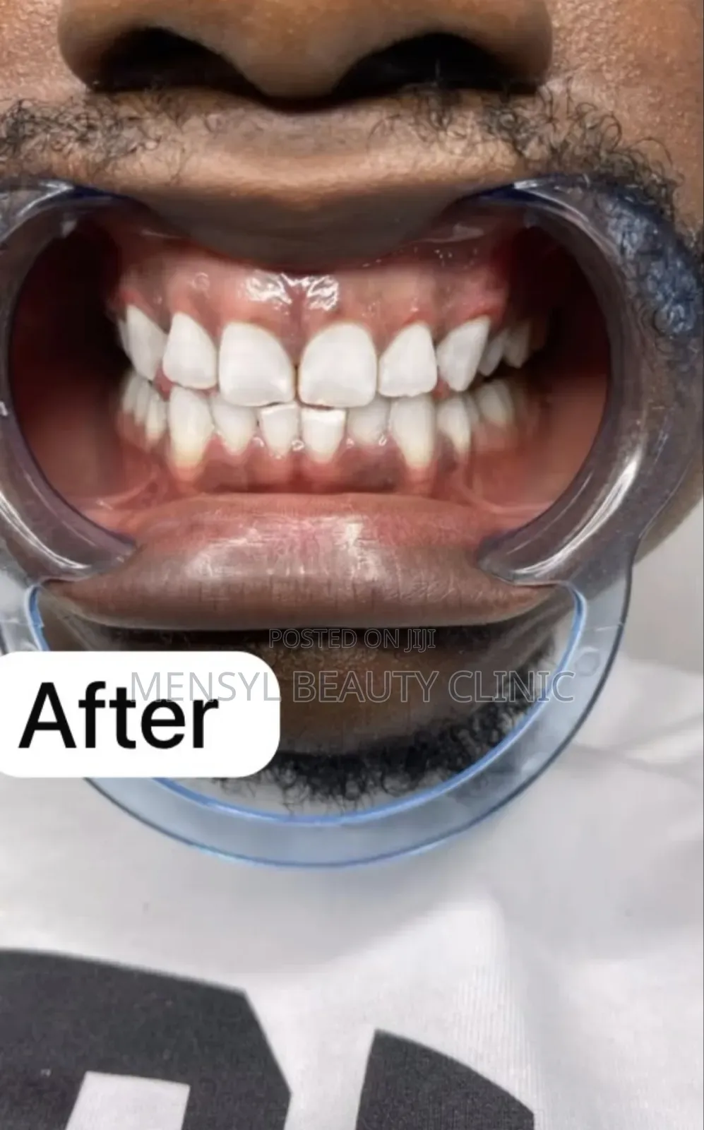 Professional Teeth Whitening