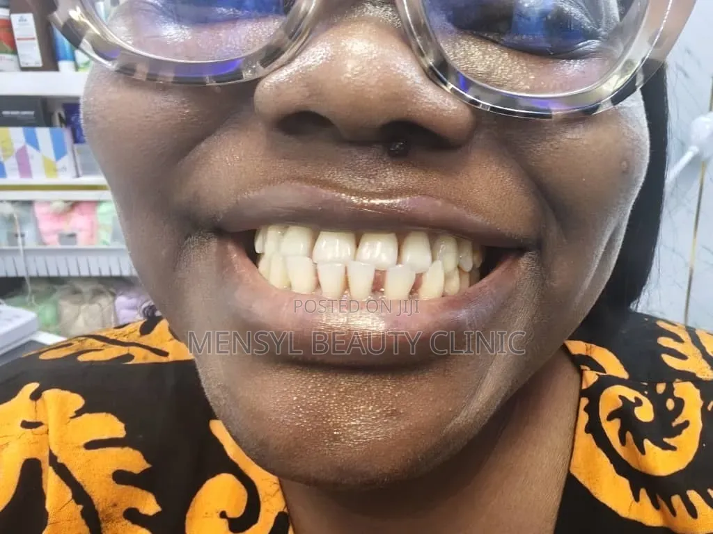 Fashion Braces Available Book Appointment